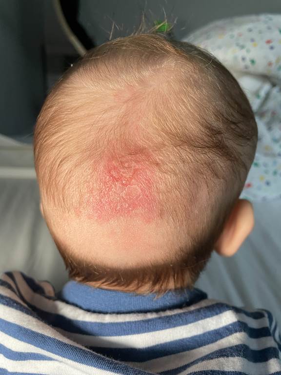 What Cradle Cap looks like