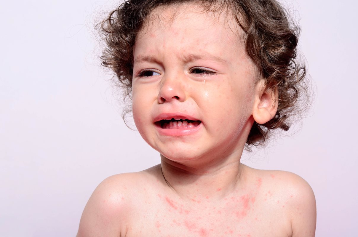 child with rash