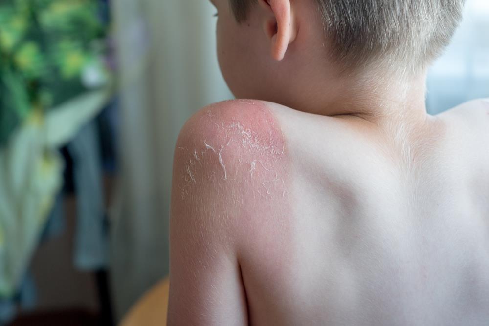 little boy with sunburn