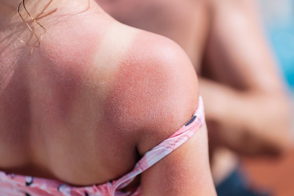 little girl with sunburn