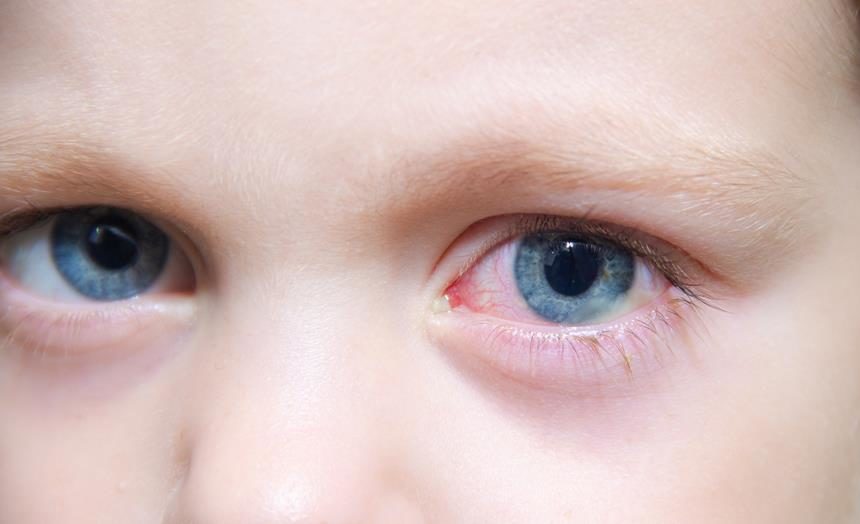 little girl with pink eye