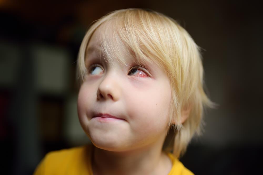 little girl with conjunctivitis