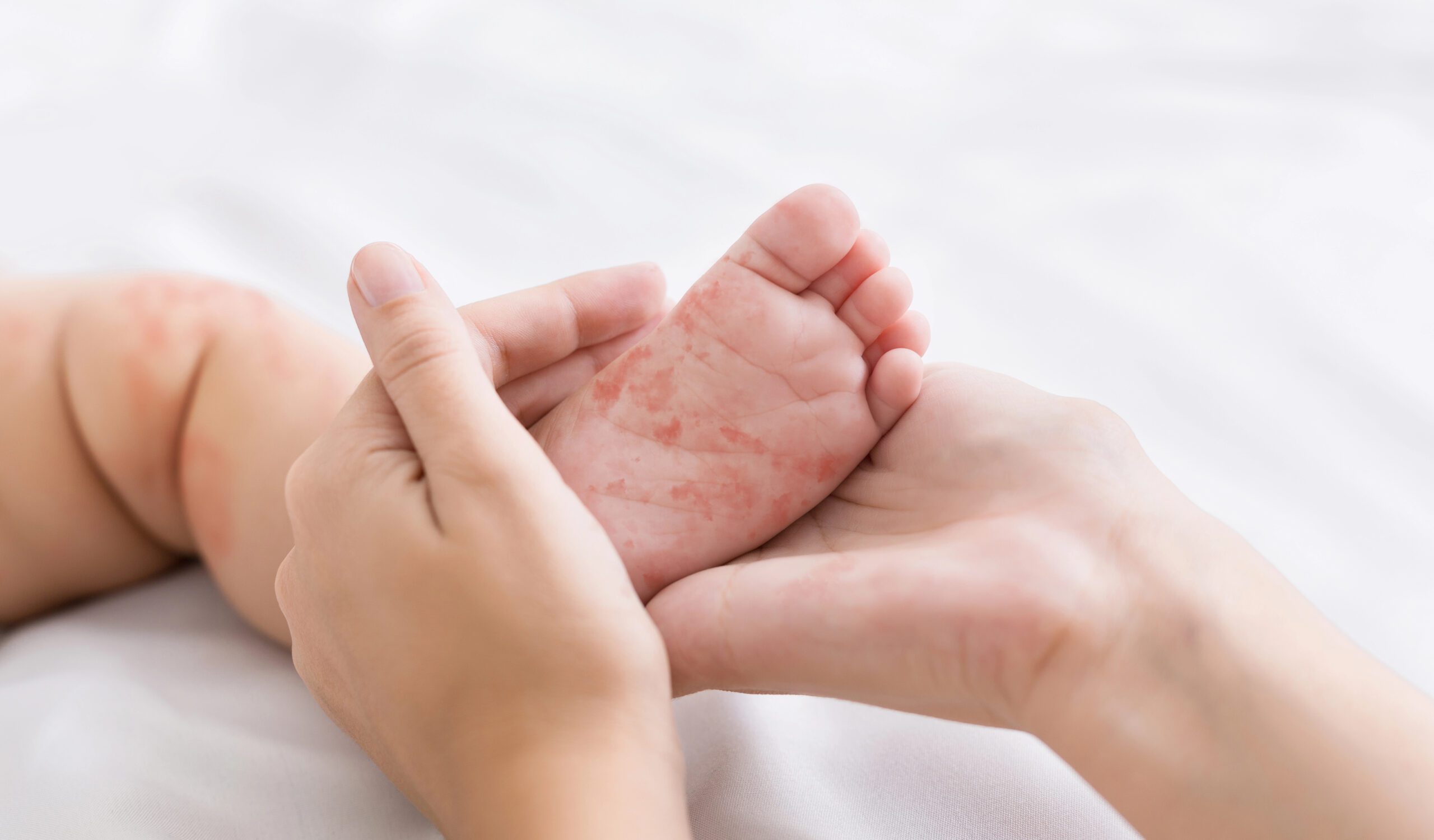 Measles Outbreak
